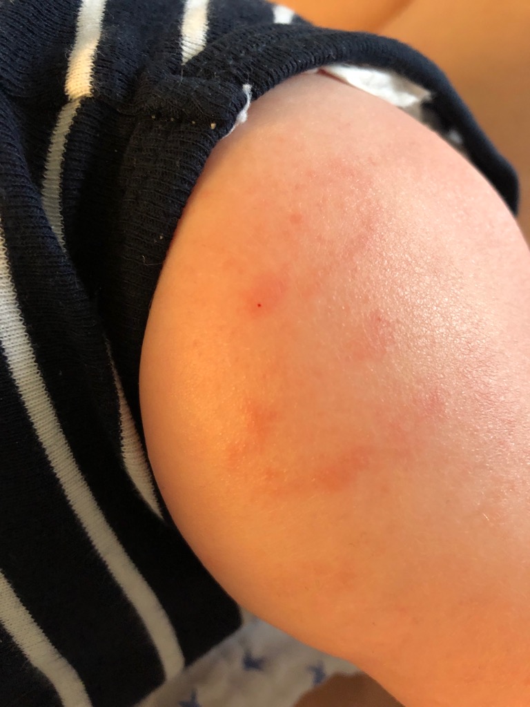 Hjælp, min baby har børneeksem!